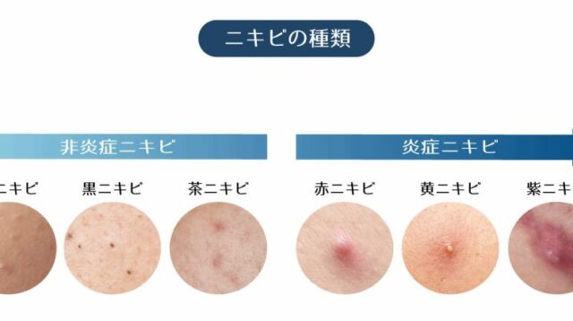 acne_gradation-1024x442