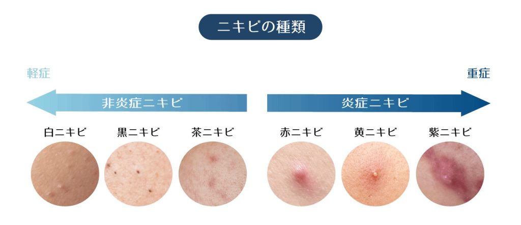 acne_gradation-1024x442