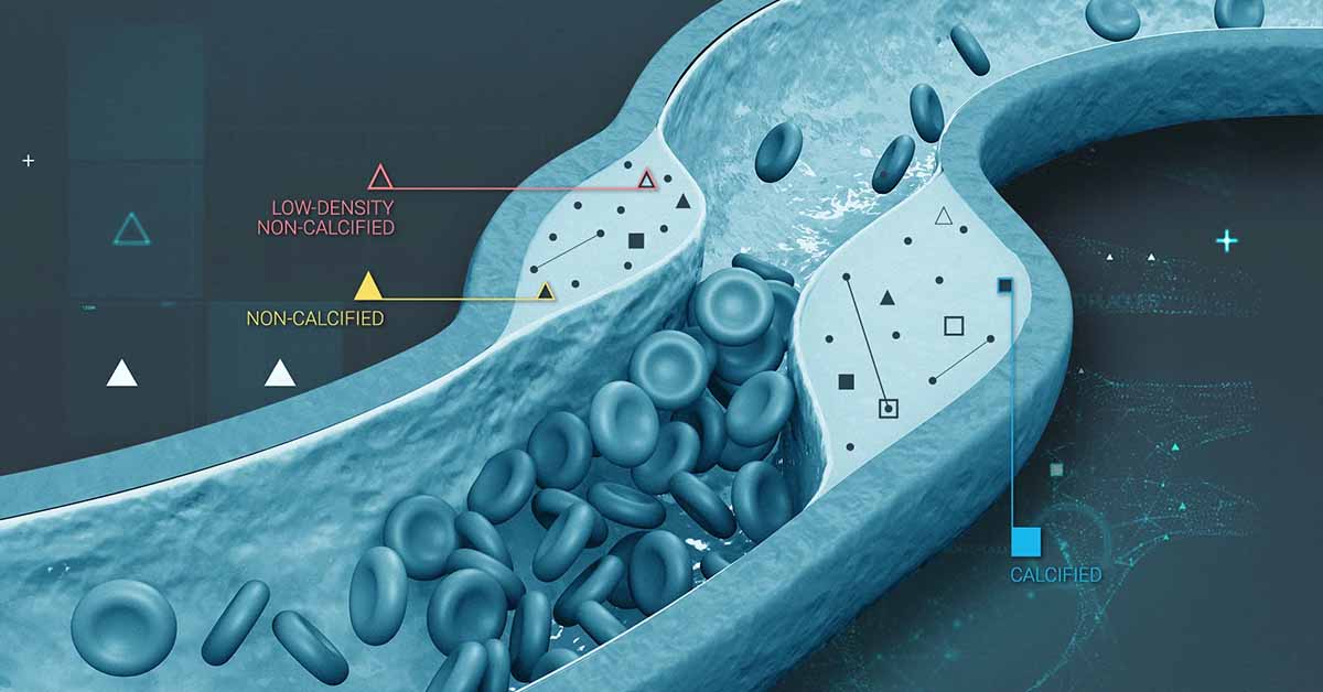 how-plaque-affects-heart-health-featured-image-blog