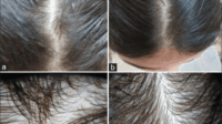 vitamin-d-hair-growth-before-after-te-case
