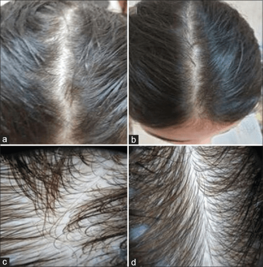 vitamin-d-hair-growth-before-after-te-case